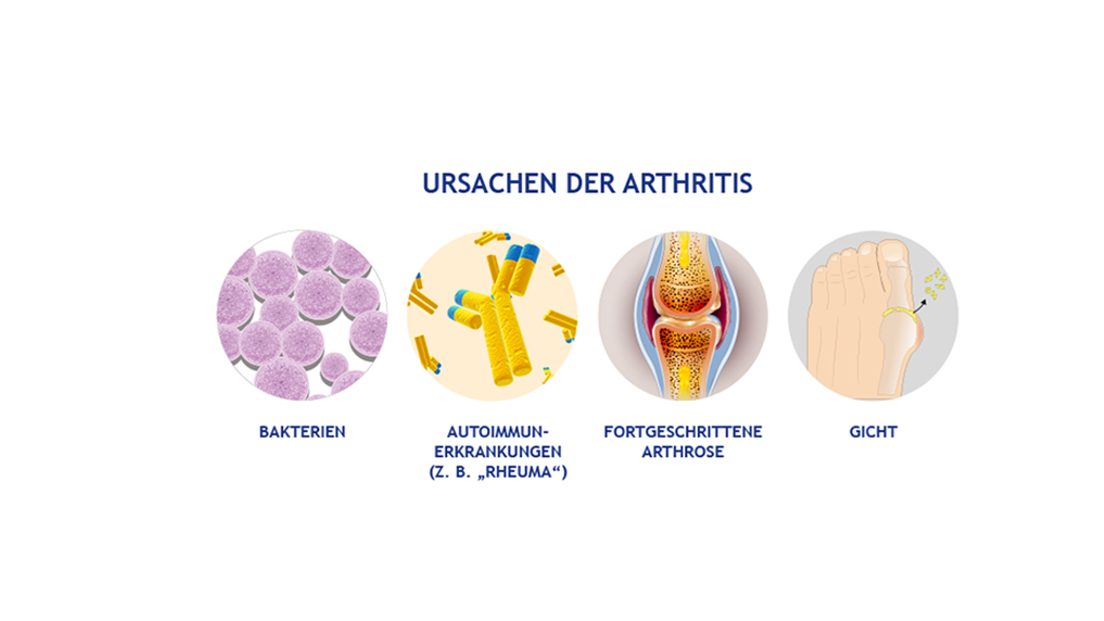 Arthritis: Die möglichen Ursachen sind vielfältig