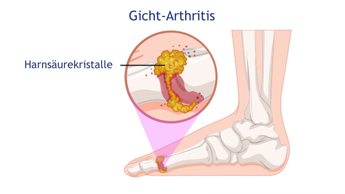 Gicht-Arthritis